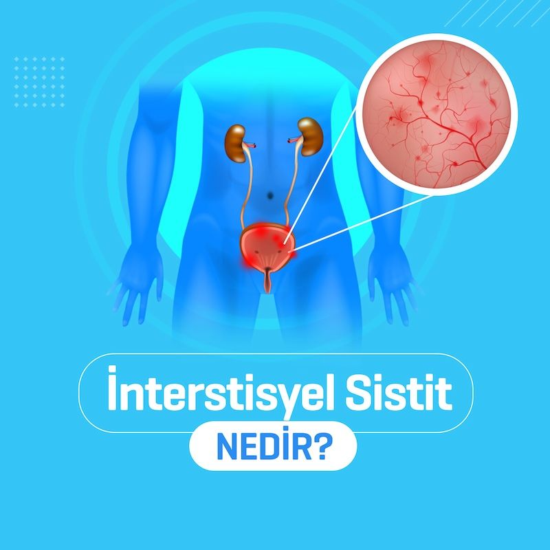 interstisyel sistit nedir