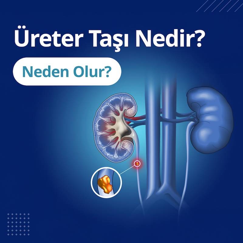 ureter tasi nedir