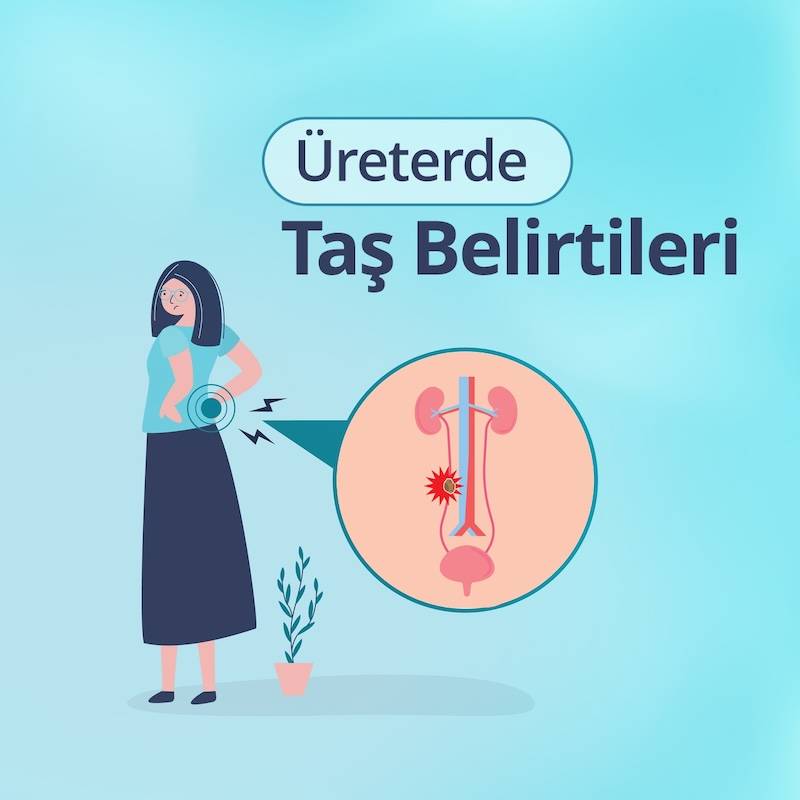 ureterde tas belirtileri