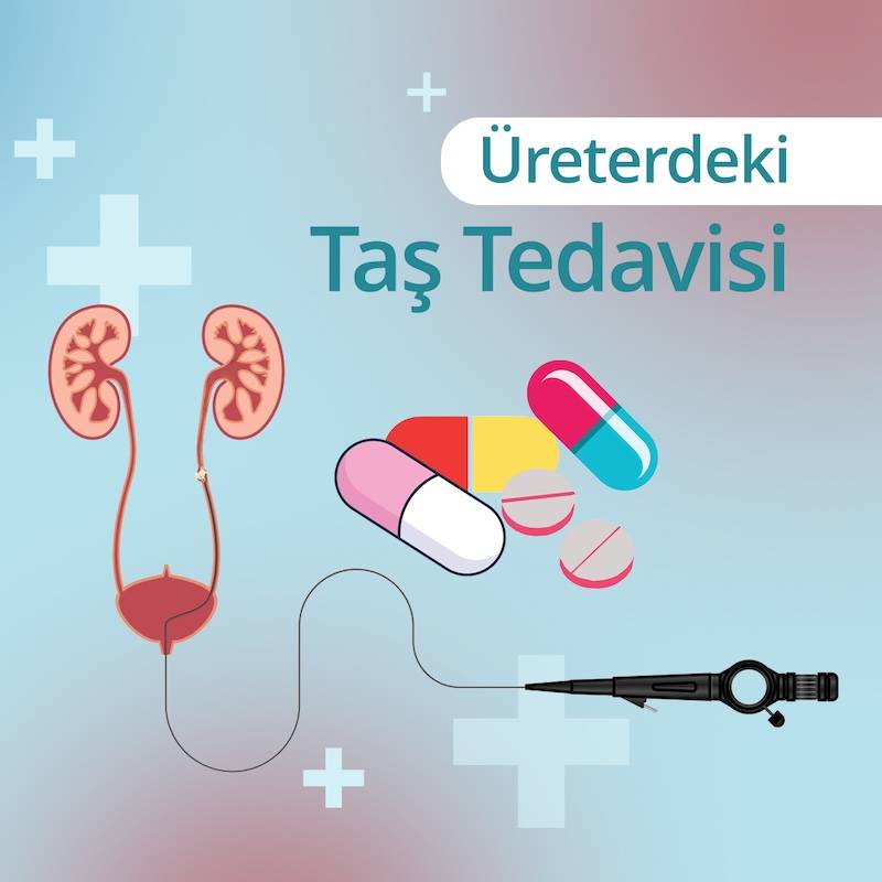 ureterdeki tas tedavisi