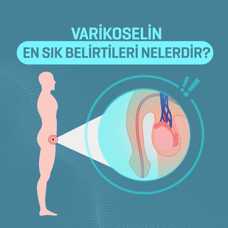 varikoselin en cok belirtileri nelerdir
